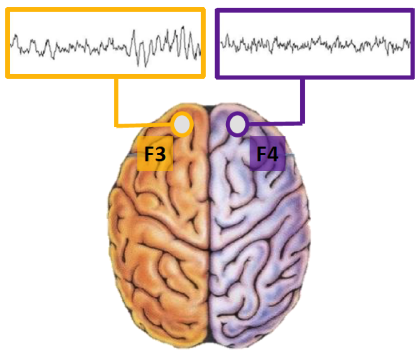 NEUROFEEDBACK DELLASIMMETRIA ALFA FRONTALE PER LA RIDUZIONE DEL